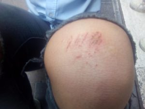 Blessures au genou de Soline suite aux violences policières du 15 septembre